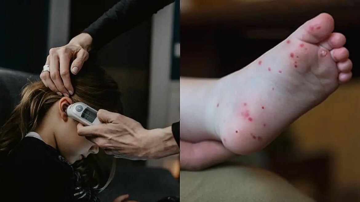 Niño con síntomas del virus Coxsackie en manos y boca.